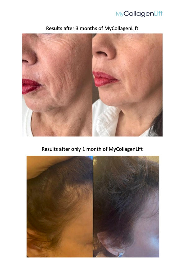 MyCollagenLift